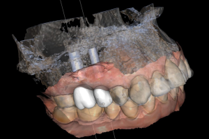 Digitale Implantatplanung